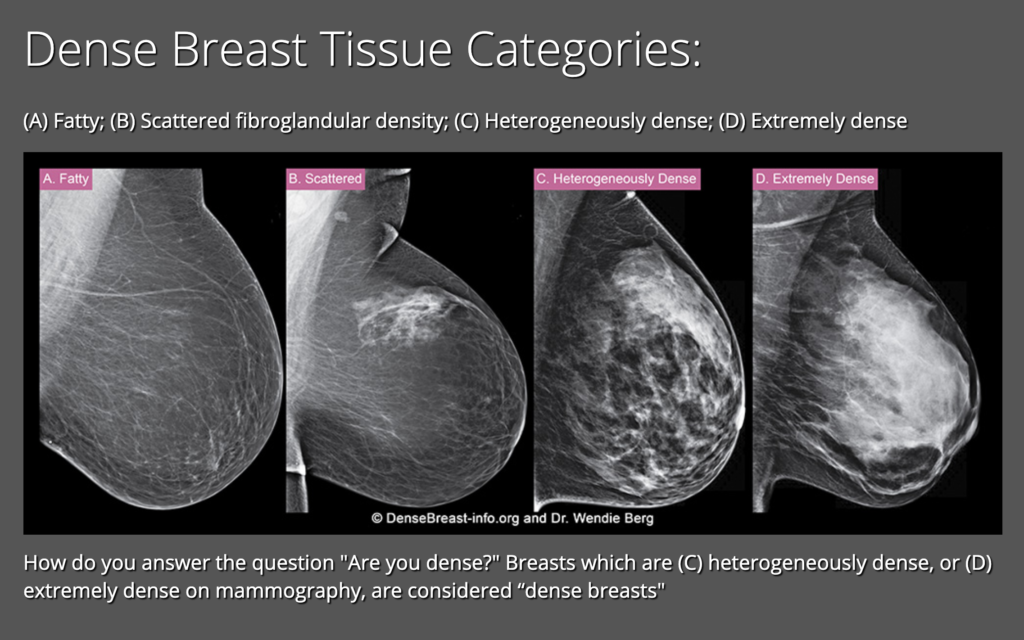 Can Mammograms Detect Stage 1 Breast Cancer?